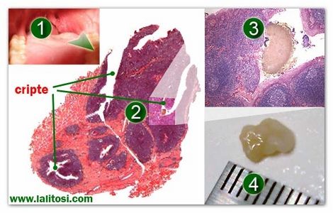 cripte tonsillari e tonsilloliti